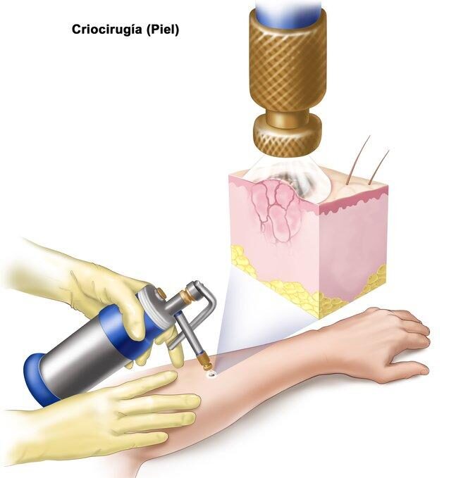 Crioterapia