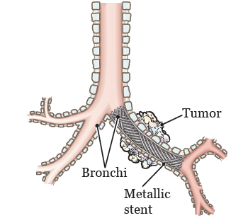 Stent Traqueal o bronquial