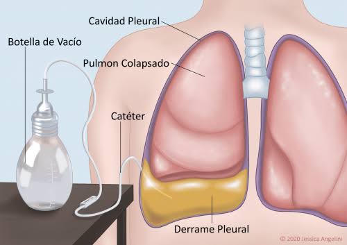 Derrame Pleural