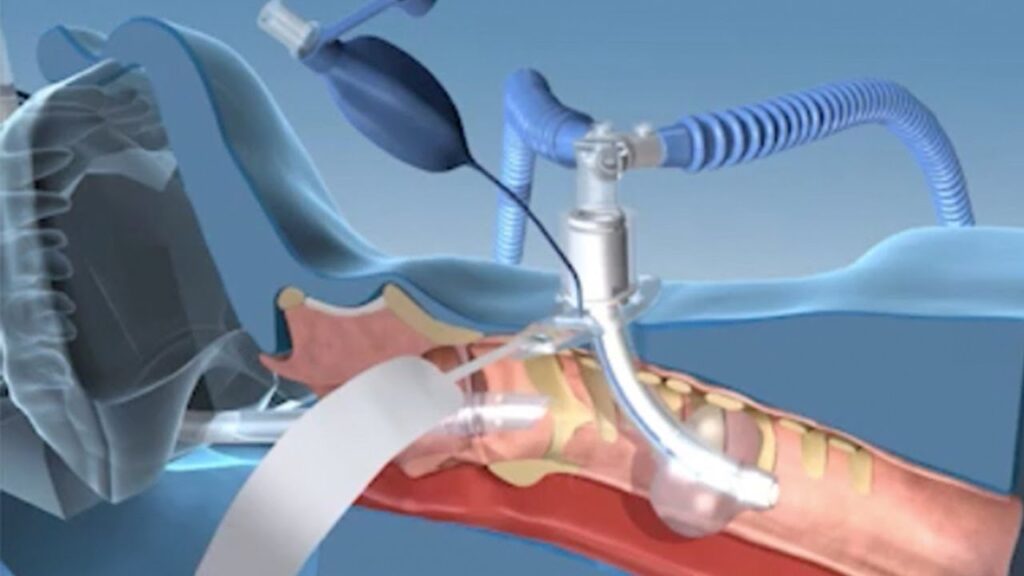 Traqueostomía percutánea